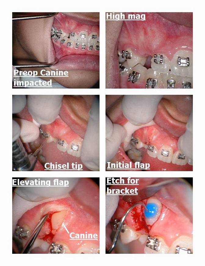 Resize of Orthodontic exposure of canine pg 1.jpg